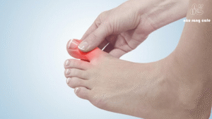 Công dụng của cà phê còn giúp bệnh gout